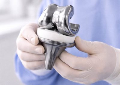 Prótesis total de rodilla en paciente con artrosis avanzada